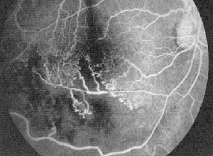 Figura ilustrativa afeccion de retinopatía diabética