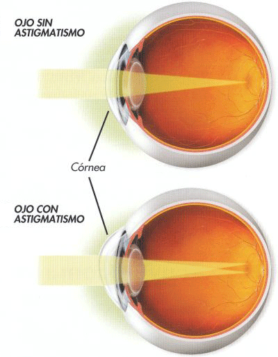 Figura ilustrativa afeccion de astigmatismo