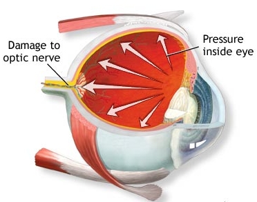 Figura ilustrativa glaucoma