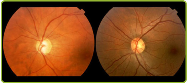 Foto: tipos de glaucoma