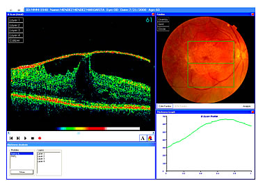 Figura ilustrativa OCT de retinopatía diabética